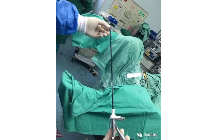 德国:软镜肾结石手术的预置支架效果要优于输尿管结石预置支架